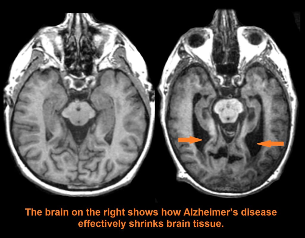 Alzheimer’s Awareness Month - NightHawk Radiology